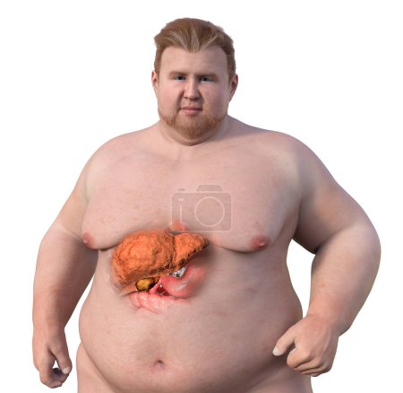 Foto de Una ilustración médica en 3D con un hombre con sobrepeso y piel transparente, mostrando el hígado y destacando la presencia de esteatosis hepática. - Imagen libre de derechos