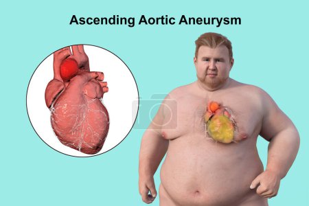 Eine wissenschaftliche 3D-Illustration, die einen fettleibigen Mann mit transparenter Haut zeigt und ein aufsteigendes Aortenaneurysma enthüllt, ein Konzept, das den Zusammenhang zwischen aufsteigendem Aortenaneurysma und Fettleibigkeit hervorhebt.