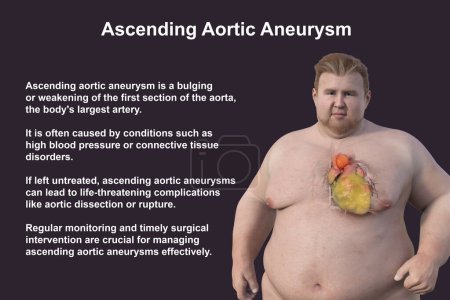 Photo for A 3D scientific illustration depicting an obese man with transparent skin, revealing an ascending aortic aneurysm, a concept highlighting the association of ascending aortic aneurysm with obesity. - Royalty Free Image