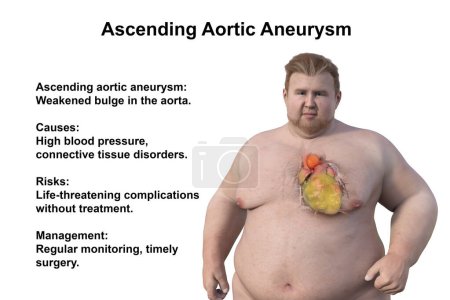 Photo for A 3D scientific illustration depicting an obese man with transparent skin, revealing an ascending aortic aneurysm, a concept highlighting the association of ascending aortic aneurysm with obesity. - Royalty Free Image