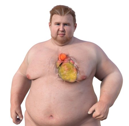 Foto de Una ilustración científica en 3D que representa a un hombre obeso con piel transparente, revelando un aneurisma aórtico ascendente, un concepto que destaca la asociación del aneurisma aórtico ascendente con la obesidad. - Imagen libre de derechos