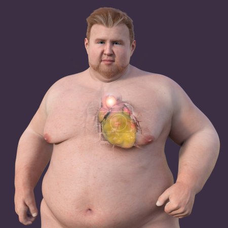 Téléchargez les photos : Illustration scientifique 3D représentant un homme obèse à la peau transparente, révélant un anévrisme aortique ascendant, un concept mettant en évidence l'association de l'anévrisme aortique ascendant avec l'obésité. - en image libre de droit