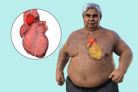 Wissenschaftliche 3D-Illustration eines übergewichtigen Mannes mit durchsichtiger Haut, die ein aufsteigendes Aortenaneurysma zeigt, ein Konzept, das die Assoziation von aufsteigendem Aortenaneurysma mit Fettleibigkeit hervorhebt.