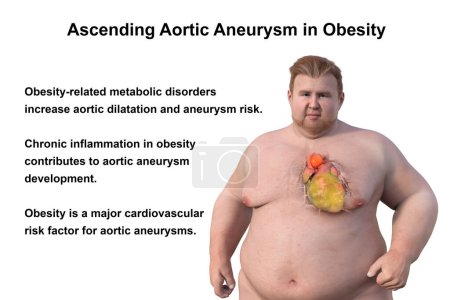 Téléchargez les photos : Illustration scientifique 3D représentant un homme obèse à la peau transparente, révélant un anévrisme aortique ascendant, un concept mettant en évidence l'association de l'anévrisme aortique ascendant avec l'obésité. - en image libre de droit