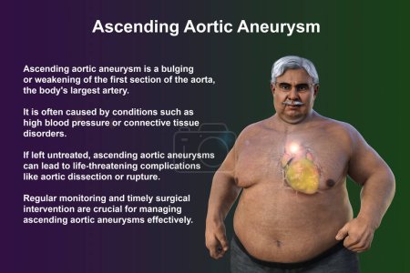 Photo for 3D scientific illustration depicting a senior obese man with transparent skin, revealing an ascending aortic aneurysm, a concept highlighting the association of ascending aortic aneurysm with obesity. - Royalty Free Image