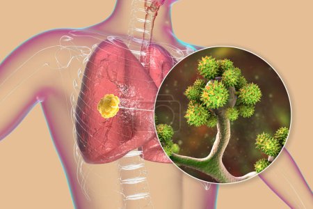 Foto de Lesión de mucormicosis pulmonar y vista de cerca de los hongos Cunninghamella bertholletiae, uno de los agentes causantes de la mucormicosis pulmonar en humanos, ilustración 3D. - Imagen libre de derechos