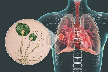 Foto de Lesión de mucormicosis pulmonar y vista de cerca de hongos Rhizopus, uno de los agentes causantes de la mucormicosis pulmonar en humanos, ilustración 3D. - Imagen libre de derechos