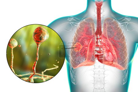 Téléchargez les photos : Lésion de la mucormycose pulmonaire et vue rapprochée des champignons Rhizopus, l'un des agents responsables de la mucormycose pulmonaire chez l'homme, illustration 3D. - en image libre de droit