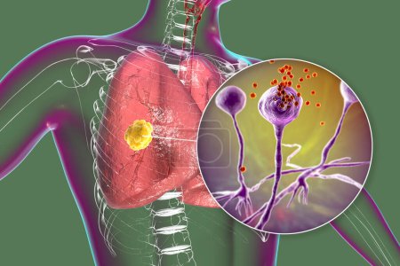 Téléchargez les photos : Lésion de la mucormycose pulmonaire et vue rapprochée des champignons Rhizopus, l'un des agents responsables de la mucormycose pulmonaire chez l'homme, illustration 3D. - en image libre de droit