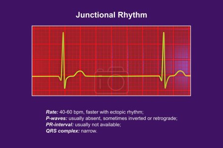 Téléchargez les photos : Électrocardiogramme montrant un rythme conjonctionnel, qui se produit lorsque les signaux électriques dans le cœur proviennent de la jonction auriculo-ventriculaire au lieu du nœud sinoatrial, illustration 3D. - en image libre de droit