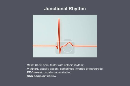 Téléchargez les photos : Électrocardiogramme montrant un rythme conjonctionnel, qui se produit lorsque les signaux électriques dans le cœur proviennent de la jonction auriculo-ventriculaire au lieu du nœud sinoatrial, illustration 3D. - en image libre de droit