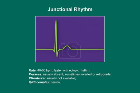 Photo for Electrocardiogram displaying a junctional rhythm, which occurs when the electrical signals in the heart originate from the atrioventricular junction instead of the sinoatrial node, 3D illustration. - Royalty Free Image