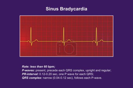 Photo for An electrocardiogram displaying sinus bradycardia, a condition characterized by a slow heart rate originating from the sinus node, typically below 60 beats per minute, 3D illustration. - Royalty Free Image