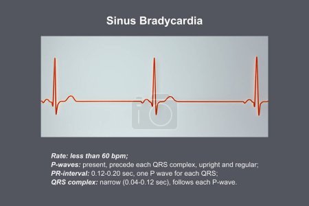 Ein Elektrokardiogramm mit Sinus-Bradykardie, einem Zustand, der durch eine langsame Herzfrequenz vom Sinusknoten ausgeht, typischerweise unter 60 Schlägen pro Minute, 3D-Illustration.