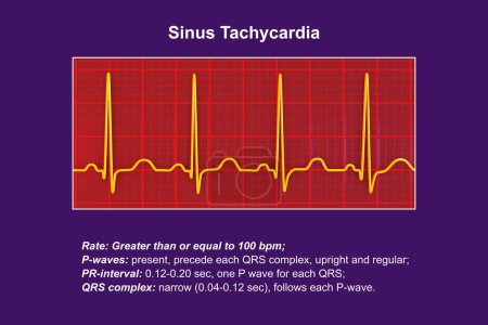 Foto de Electrocardiograma (ECG) que muestra taquicardia sinusal, un ritmo cardíaco regular con frecuencia cardíaca superior al límite superior de la normalidad de 90-100 lpm en adultos, ilustración 3D. - Imagen libre de derechos