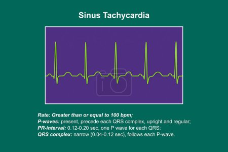 Téléchargez les photos : Électrocardiogramme (ECG) montrant une tachycardie sinusale, un rythme cardiaque régulier avec une fréquence cardiaque supérieure à la limite supérieure de la normale de 90 à 100 bpm chez les adultes, illustration 3D. - en image libre de droit