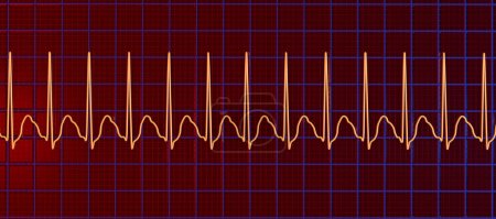 Foto de ECG en taquicardia supraventricular, una frecuencia cardíaca rápida que se origina por encima de los ventrículos, causando palpitaciones y mareos. La ilustración 3D muestra complejos QRS estrechos y ondas P ocultas en ondas T. - Imagen libre de derechos
