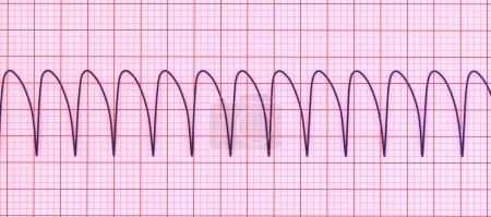 Photo for Ventricular tachycardia: A rapid heart rhythm originating in the ventricles, causes palpitations, dizziness, life-threatening symptoms. ECG shows wide QRS complexes, 3D illustration. - Royalty Free Image