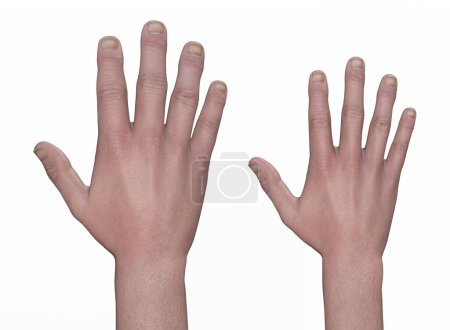 Foto de Mano con acromegalia y la misma mano sana. Ilustración 3D que muestra un aumento en el tamaño de las manos debido a la sobreproducción de somatotropina causada por un tumor de la glándula pituitaria. - Imagen libre de derechos