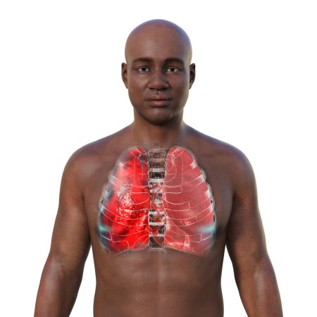 Photo for A 3D photorealistic illustration showcasing the upper half part of a man with transparent skin, revealing the lungs affected by pneumonia. - Royalty Free Image