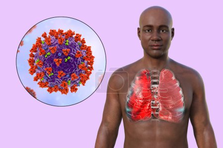 Téléchargez les photos : Illustration photoréaliste 3D montrant la moitié supérieure d'un homme à peau transparente, révélant les poumons affectés par la pneumonie à Covid-19, et vue rapprochée des virus du SRAS-CoV-2. - en image libre de droit