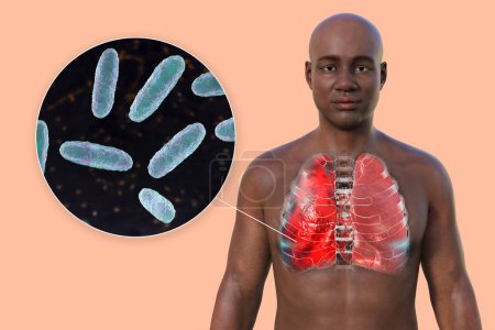 Photo for A 3D photorealistic illustration showcasing the upper half part of a man with transparent skin, revealing the lungs affected by pneumonia, and close-up view of Klebsiella pneumoniae bacteria. - Royalty Free Image