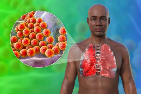 Foto de Una ilustración fotorrealista en 3D que muestra la mitad superior de un hombre con la piel transparente, revelando los pulmones afectados por la neumonía, y vista de cerca de la bacteria Staphylococcus aureus. - Imagen libre de derechos