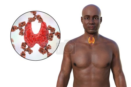 Foto de Tiroiditis autoinmune (enfermedad de Hashimoto). Ilustración 3D que muestra a un hombre con piel transparente, revelando la glándula tiroides con vista cercana de anticuerpos que atacan la glándula tiroides. - Imagen libre de derechos