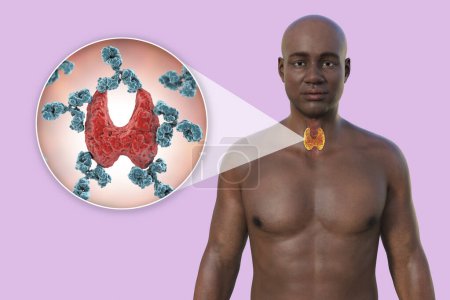 Téléchargez les photos : Thyroïdite auto-immune (maladie de Hashimoto). Illustration 3D montrant un homme à la peau transparente, révélant la glande thyroïde avec vue rapprochée des anticorps attaquant la glande thyroïde. - en image libre de droit