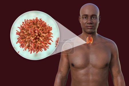 Foto de Cáncer de tiroides. Ilustración 3D que muestra a un hombre con piel transparente, revelando un tumor en la glándula tiroides con vista cercana de las células cancerosas. - Imagen libre de derechos