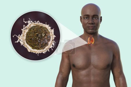 Photo for Thyroid cancer. 3D illustration showcasing a man with transparent skin, revealing a tumour in thyroid gland with close-up view of cancer cells. - Royalty Free Image