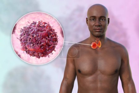 Photo for Thyroid cancer. 3D illustration showcasing a man with transparent skin, revealing a tumour in thyroid gland with close-up view of cancer cells. - Royalty Free Image