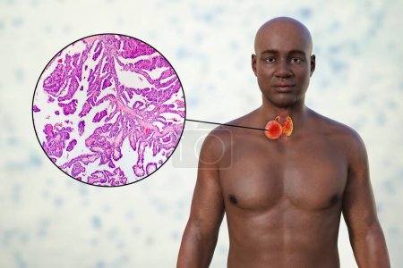 Téléchargez les photos : Cancer de la thyroïde. Illustration 3D montrant un homme à la peau transparente, révélant une tumeur dans la glande thyroïde ainsi qu'une photomicrographie du cancer de la thyroïde. - en image libre de droit