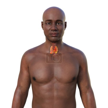 Foto de Cáncer de tiroides. Ilustración 3D que muestra a un hombre con piel transparente, revelando un tumor en la glándula tiroides. - Imagen libre de derechos