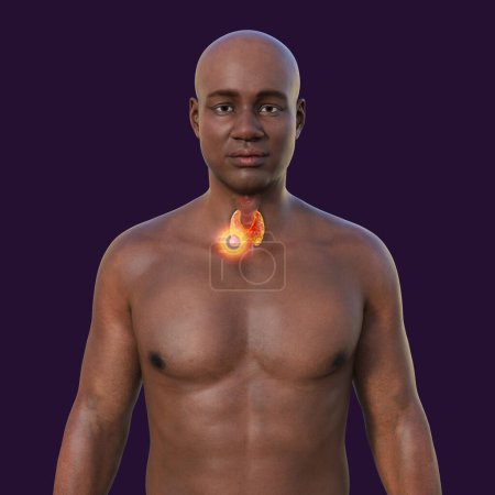 Foto de Cáncer de tiroides. Ilustración 3D que muestra a un hombre con piel transparente, revelando un tumor en la glándula tiroides. - Imagen libre de derechos