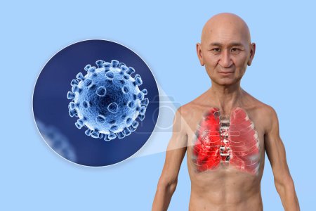 Foto de Una ilustración fotorrealista en 3D que muestra la mitad superior de un hombre con piel transparente, revelando los pulmones afectados por la neumonía Covid-19, y una vista cercana de los virus SARS-CoV-2. - Imagen libre de derechos