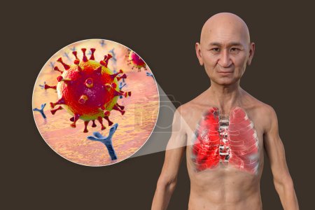 Photo for A 3D photorealistic illustration showcasing the upper half part of a man with transparent skin, revealing the lungs affected by Covid-19 pneumonia, and close-up view of SARS-CoV-2 viruses. - Royalty Free Image