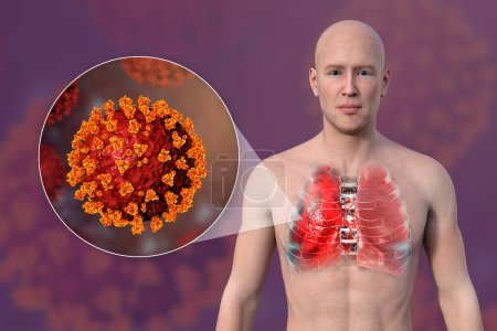 Téléchargez les photos : Illustration photoréaliste 3D montrant la moitié supérieure d'un homme à peau transparente, révélant les poumons affectés par la pneumonie à Covid-19, et vue rapprochée des virus du SRAS-CoV-2. - en image libre de droit