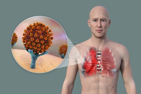 Téléchargez les photos : Illustration 3D montrant la moitié supérieure d'un homme à peau transparente, révélant les poumons affectés par la pneumonie à Covid-19, et vue rapprochée des récepteurs cellulaires de liaison du virus CoV-2 du SRAS. - en image libre de droit