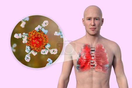 Téléchargez les photos : Illustration 3D montrant la moitié supérieure d'un homme à peau transparente, révélant les poumons affectés par la pneumonie à Covid-19, et vue rapprochée des virus du SRAS-CoV-2 entourés d'anticorps. - en image libre de droit