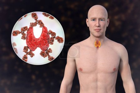 Photo for Autoimmune thyroiditis (Hashimoto's disease). 3D illustration showcasing a man with transparent skin, revealing the thyroid gland with close-up view of antibodies attacking the thyroid gland. - Royalty Free Image