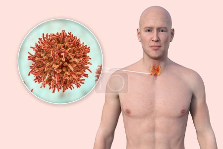 Téléchargez les photos : Cancer de la thyroïde. Illustration 3D montrant un homme à la peau transparente, révélant une tumeur dans la glande thyroïde avec vue rapprochée des cellules cancéreuses. - en image libre de droit