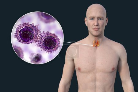 Téléchargez les photos : Cancer de la thyroïde. Illustration 3D montrant un homme à la peau transparente, révélant une tumeur dans la glande thyroïde avec vue rapprochée des cellules cancéreuses. - en image libre de droit