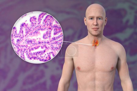 Téléchargez les photos : Cancer de la thyroïde. Illustration 3D montrant un homme à la peau transparente, révélant une tumeur dans la glande thyroïde ainsi qu'une photomicrographie du cancer de la thyroïde. - en image libre de droit
