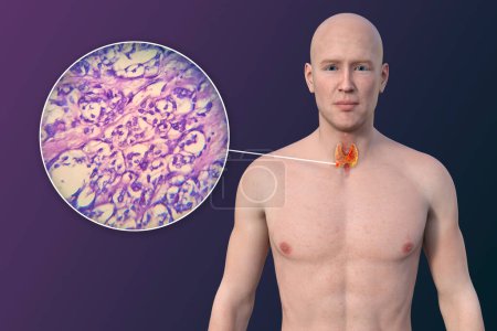 Photo for Thyroid cancer. 3D illustration showcasing a man with transparent skin, revealing a tumour in thyroid gland along with photomicrograph of thyroid cancer. - Royalty Free Image