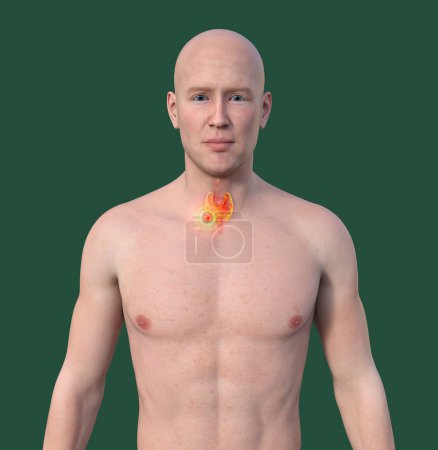 Photo for Thyroid cancer. 3D illustration showcasing a man with transparent skin, revealing a tumour in thyroid gland. - Royalty Free Image