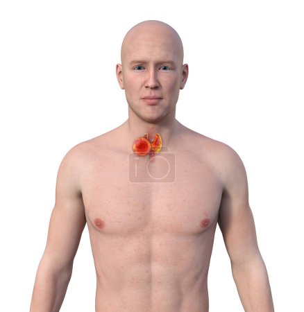Photo for Thyroid cancer. 3D illustration showcasing a man with transparent skin, revealing a tumour in thyroid gland. - Royalty Free Image