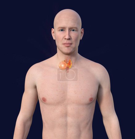 Téléchargez les photos : Cancer de la thyroïde. Illustration 3D montrant un homme à la peau transparente, révélant une tumeur dans la glande thyroïde. - en image libre de droit