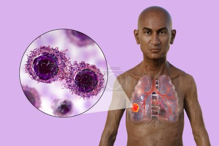Photo for Lung cancer. A 3D photorealistic illustration of the upper half part of a man with transparent skin, revealing the presence of a tumour in lungs, with a close-up view of cancer cells. - Royalty Free Image