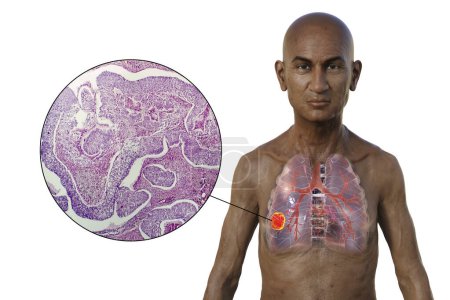 Foto de Una ilustración fotorrealista 3D de la mitad superior de un hombre con piel transparente, que revela la presencia de cáncer de pulmón, junto con una imagen micrográfica de adenocarcinoma de pulmón. - Imagen libre de derechos